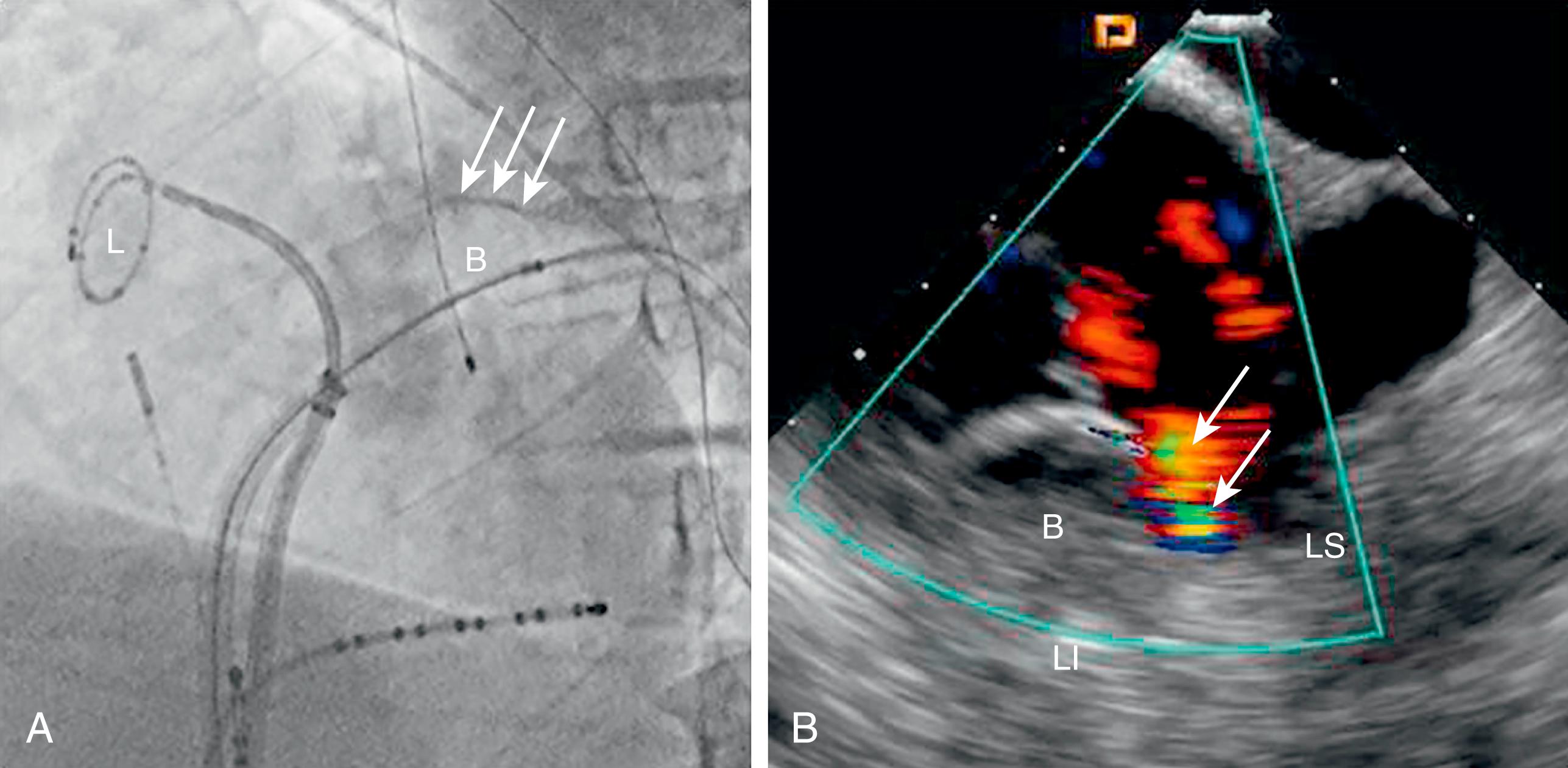 Fig. 66.2, Intracardiac echocardiography (ICE) allows imaging of both the intracardiac anatomy and catheters and devices, allowing for anatomically accurate positioning.