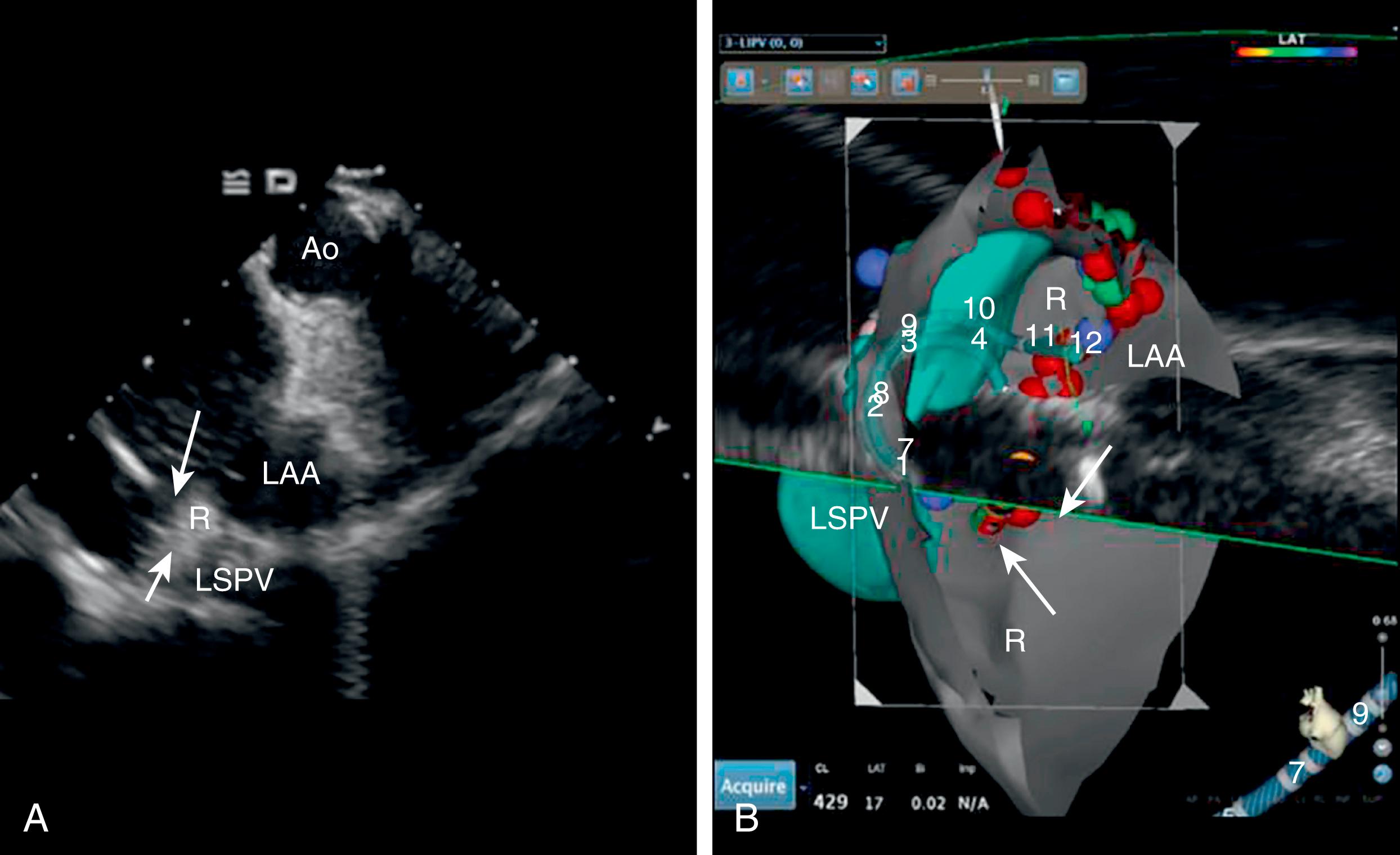 Fig. 66.3, Integration of intracardiac echocardiography (ICE) with electroanatomic mapping systems can be helpful to guide mapping and ablation of complex or intracavitary structures.