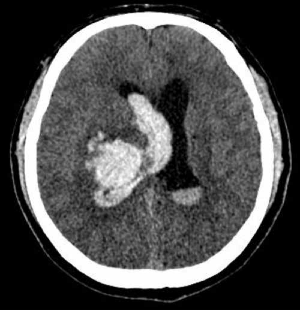 Fig. 28.1, Right thalamic intracerebral hemorrhage with intraventricular extension.