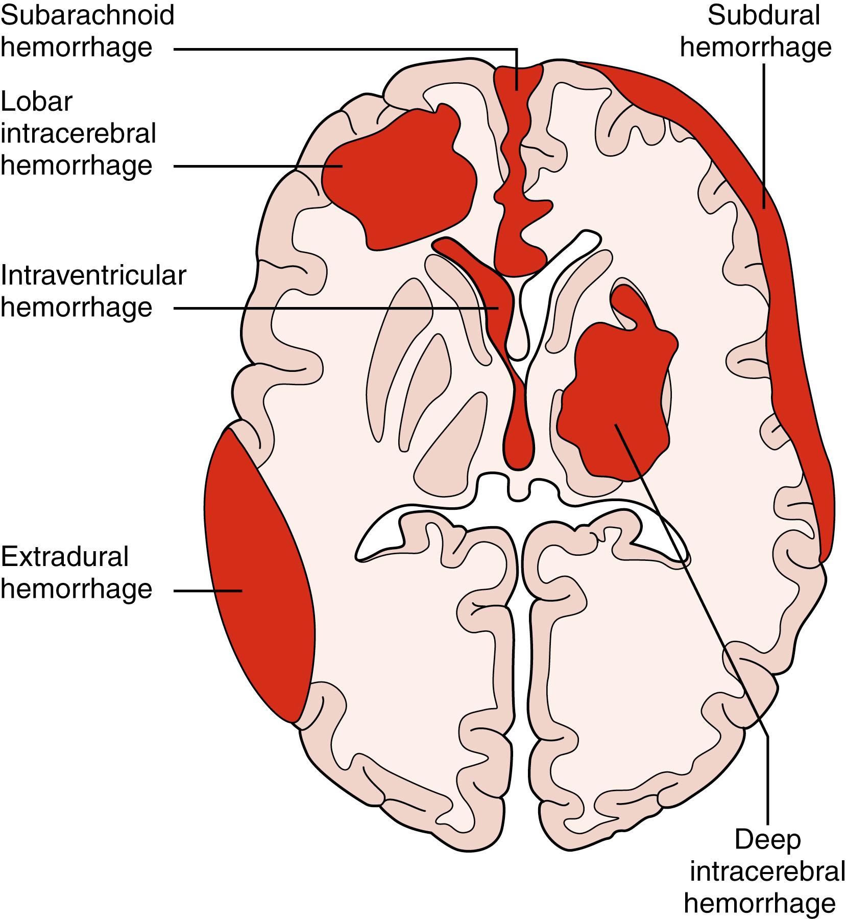 Fig. 28.2, Locations of intracranial hemorrhage.