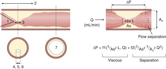 Fig. 5.1, Left: Diagram of coronary stenosis showing seven factors that produce resistance to flow: (1) entrance angle; (2) diseased segment length; (3) stenosis length; (4–6) shape factors of lumen area (minimum lumen diameter, minimum lumen area, eccentricity of stenosis); and (7) area of reference vessel. Right: Total pressure loss across a stenosis is derived from two sources: the frictional losses along the leading edge of the stenosis and the inertial losses stemming from the sudden expansion, which causes flow separation and eddies (exit losses). Frictional losses are linearly related to flow by Poiseuille’s law, and inertial losses (exit losses) increase with the square of the flow (Bernoulli’s law). The total change in pressure gradient (ΔP) is the sum of the two: the loss coefficients, f1 and f2, are functions of stenosis geometry and rheologic properties of blood (viscosity and density). The graphic representation of this equation results in a quadratic relationship, in which the curvilinear shape demonstrates the presence of nonlinear exit losses. If no stenosis is present, the second term is zero, and the curve becomes a straight line (with a positive slope that depends on the diameter of the vessel, based on Poiseuille’s law). A n , Area of the normal segment; As, area of the stenosis; L, length; Q, flow .