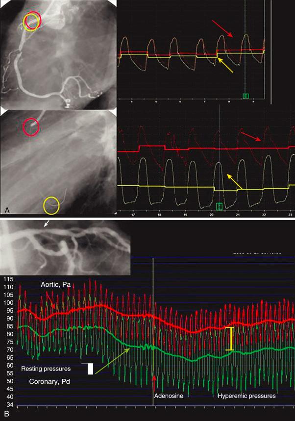 Fig. 5.5, (A) Top: The guidewire sensor and guide catheter (red and yellow circles) are shown in the proximal right coronary artery with corresponding pressures depicted on the right, showing “equalization” of pressures. Bottom: The guidewire has been advanced across the right coronary artery lesion and now is in the distal vessel with corresponding pressure loss as depicted on the right. (B) Fractional flow reserve (FFR) measurement across a proximal left anterior descending coronary artery lesion. The red pressure tracing is aortic guide catheter pressure, and the green tracing is coronary wire pressure. Adenosine is started, and the tracings from right to left reflect the changes over time. At the yellow bar , which reflects the lowest distal coronary pressure divided by aortic pressure (Pd/Pa) at steady state, the FFR is computed. FFR = Pd/Pa, or 65/90 (0.72). Pa, Aortic pressure; Pd, distal pressure.