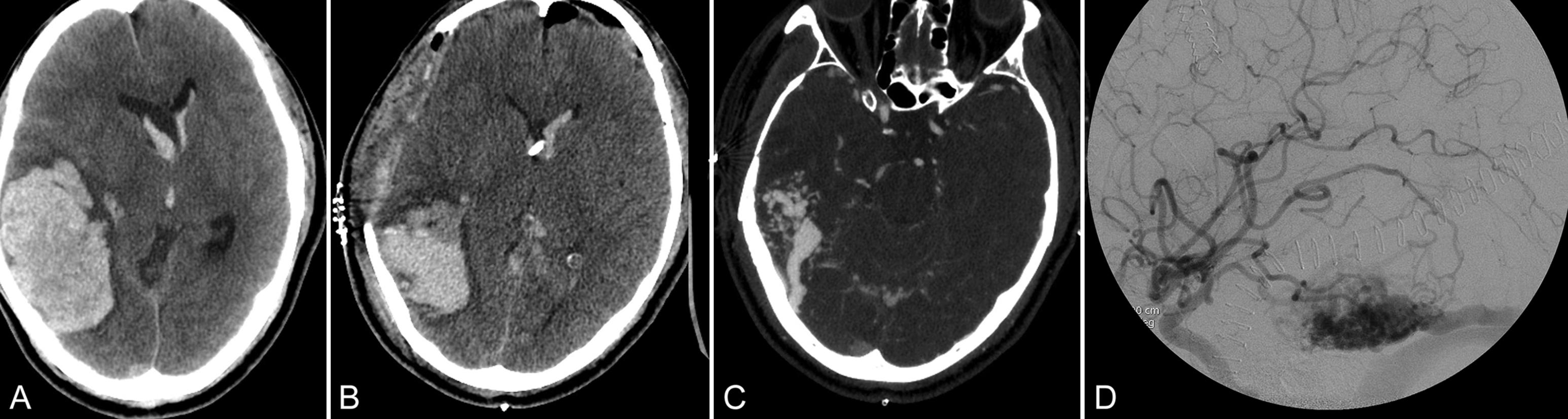 Fig. 27.1, Neuroimaging of a ruptured iAVM. ( A ) CT scan showing an acute right temporoparietal intraparenchymal hemorrhage. ( B ) CT scan obtained after emergent decompressive hemicraniectomy, which was required to relieve the mass effect. ( C ) CT angiogram showing the underlying AVM. ( D ) Digital subtraction angiogram demonstrating the AVM with feeders and draining vein.