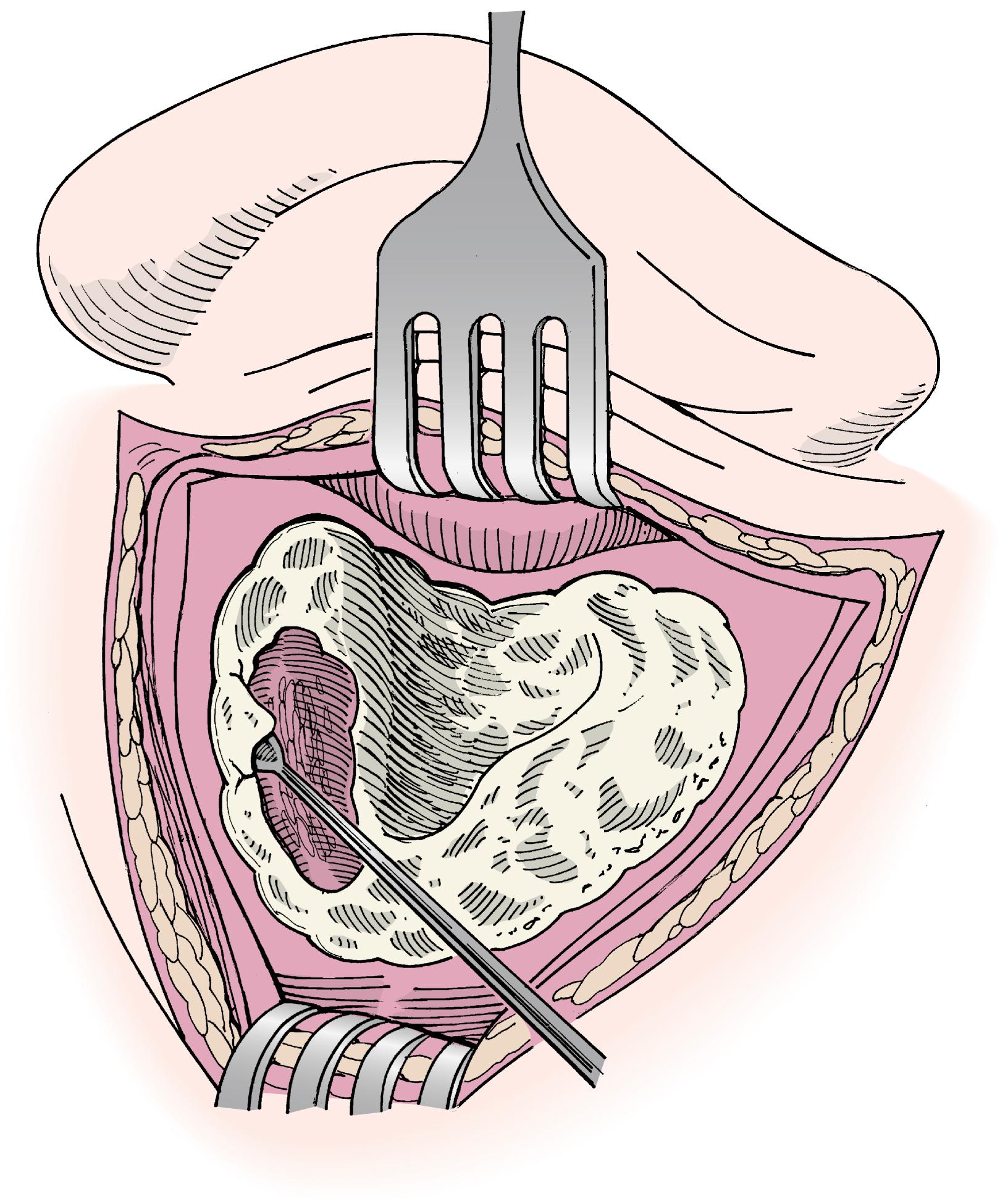 Fig. 130.2, Exposure and drainage of an epidural abscess with wide exposure of the middle fossa dura.