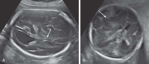 Fig. 40.4, Subdural hematoma. (A) Mass effect with midline shift (arrow) . (B) In the coronal view, most of the intracranial cavity is occupied by low-level echoes, and the cerebral architecture is distorted. The diagnosis of an ICH is not obvious on US and was mostly suggested by the medical history of anticoagulant use.