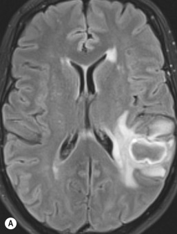 Fig. 57.2, Pyogenic Brain Abscess in a 40-Year-Old Female Patient.