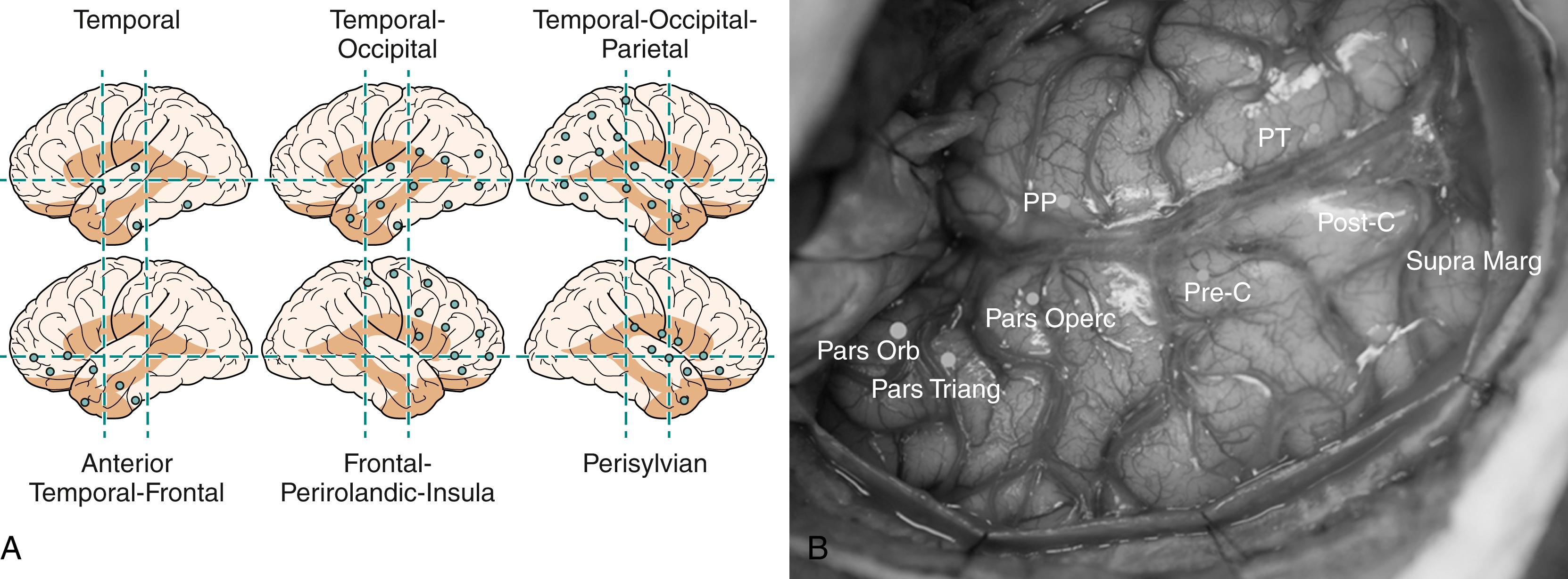 Figure 90.2, Patterns of stereo-electroencephalography (SEEG) implantation.