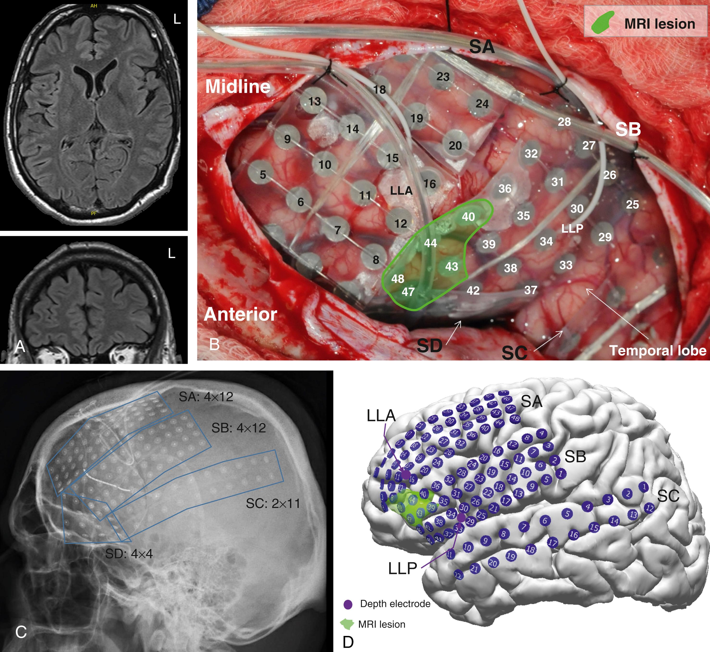 Figure 89.2, Configuration of subdural electrodes.