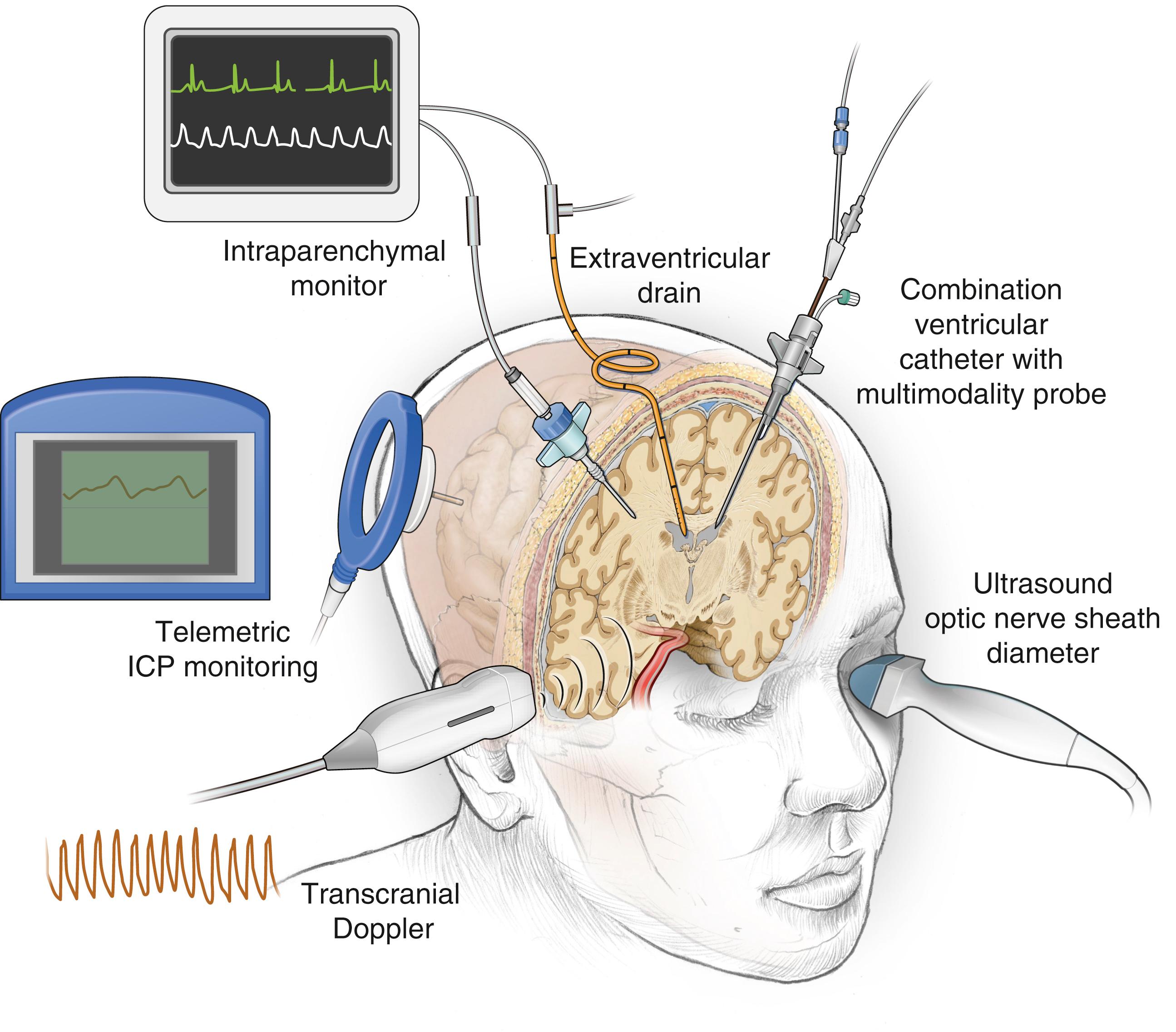 Figure 37.1, There are many invasive and noninvasive methods for intracranial pressure (ICP) monitoring, some of which are shown here. See the text for detailed descriptions of each method.