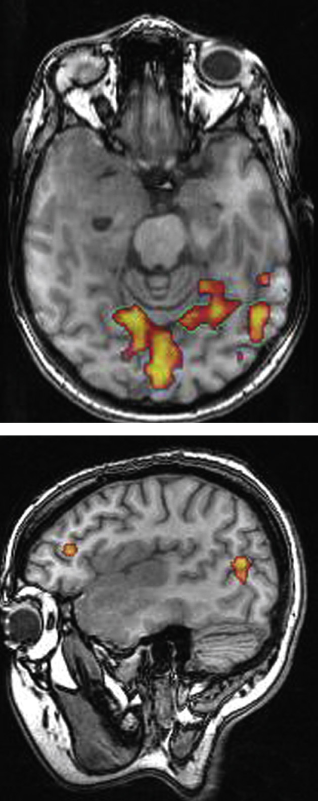 fMRI in a patient with a right peri-insular and temporal lobe tumour. Images acquired during a picture-naming task show activation in the visual cortex and in the left Broca's area, which lies outside the tumour. *