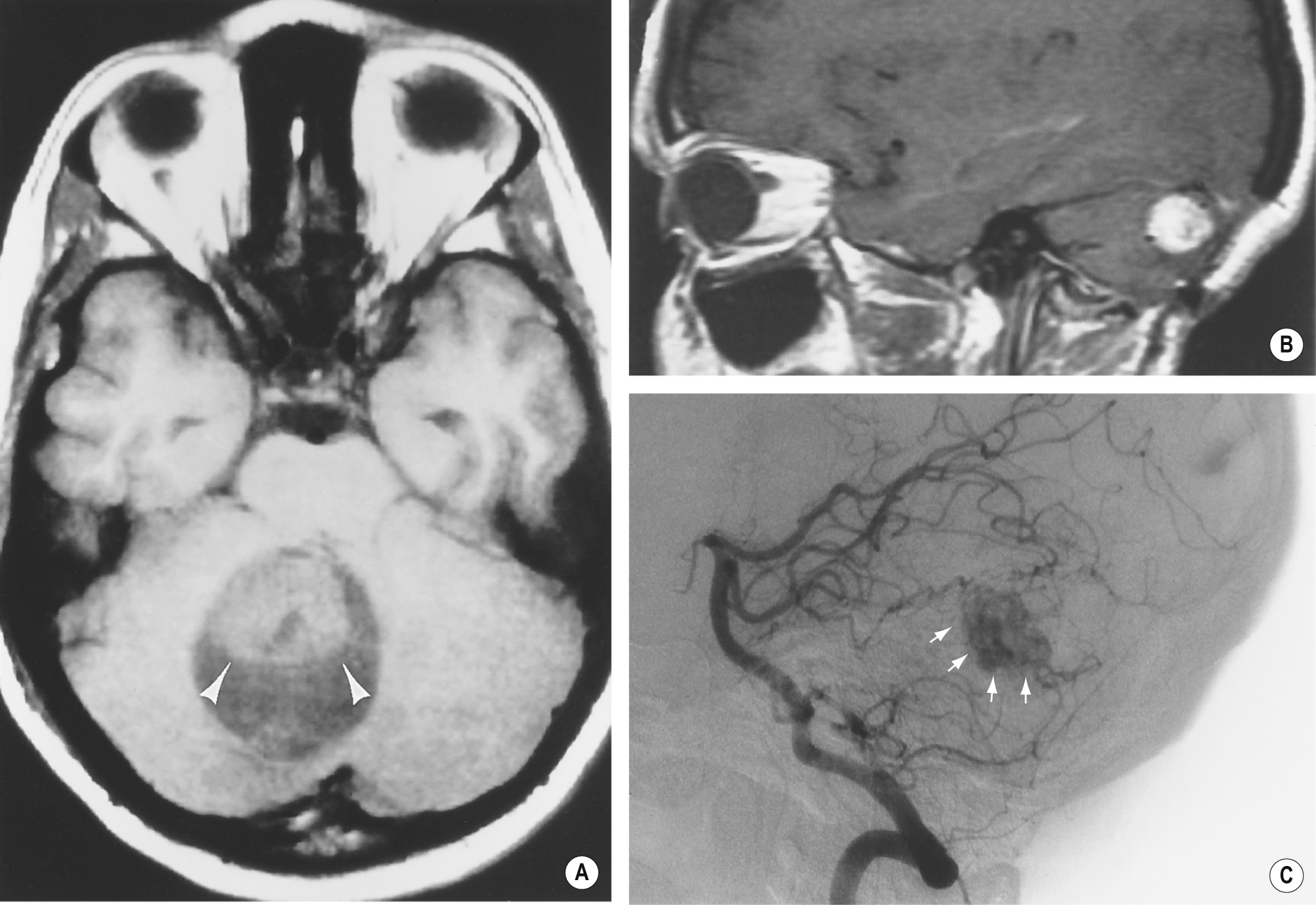 Haemangioblastoma of the cerebellum. (A) T1WI demonstrating a haemangioblastoma with both a cyst and mural nodule (arrowheads). (B) T1WI + Gad demonstrates an enhancing solid haemangioblastoma with small flow voids along its circumference. (C) A vertebral artery angiogram demonstrates a tumour stain (arrows) with the vascular supply from the posterior inferior cerebellar artery and branches of the superior cerebellar artery. +