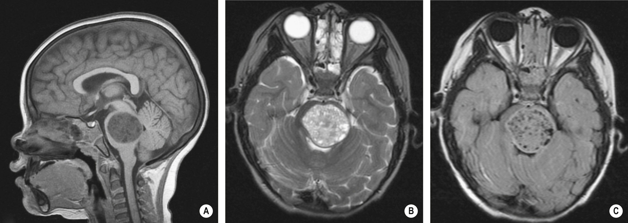 Brainstem gliomas. (A) Sagittal T1-weighted magnetic resonance image showing well-marginated central brainstem primitive neuroectodermal tumours. (B) Axial T2-weighted image showing heterogeneous signal of tumour. (C) Axial fluid-attenuated inversion recovery (FLAIR) image showing multiple small central cysts. ©24