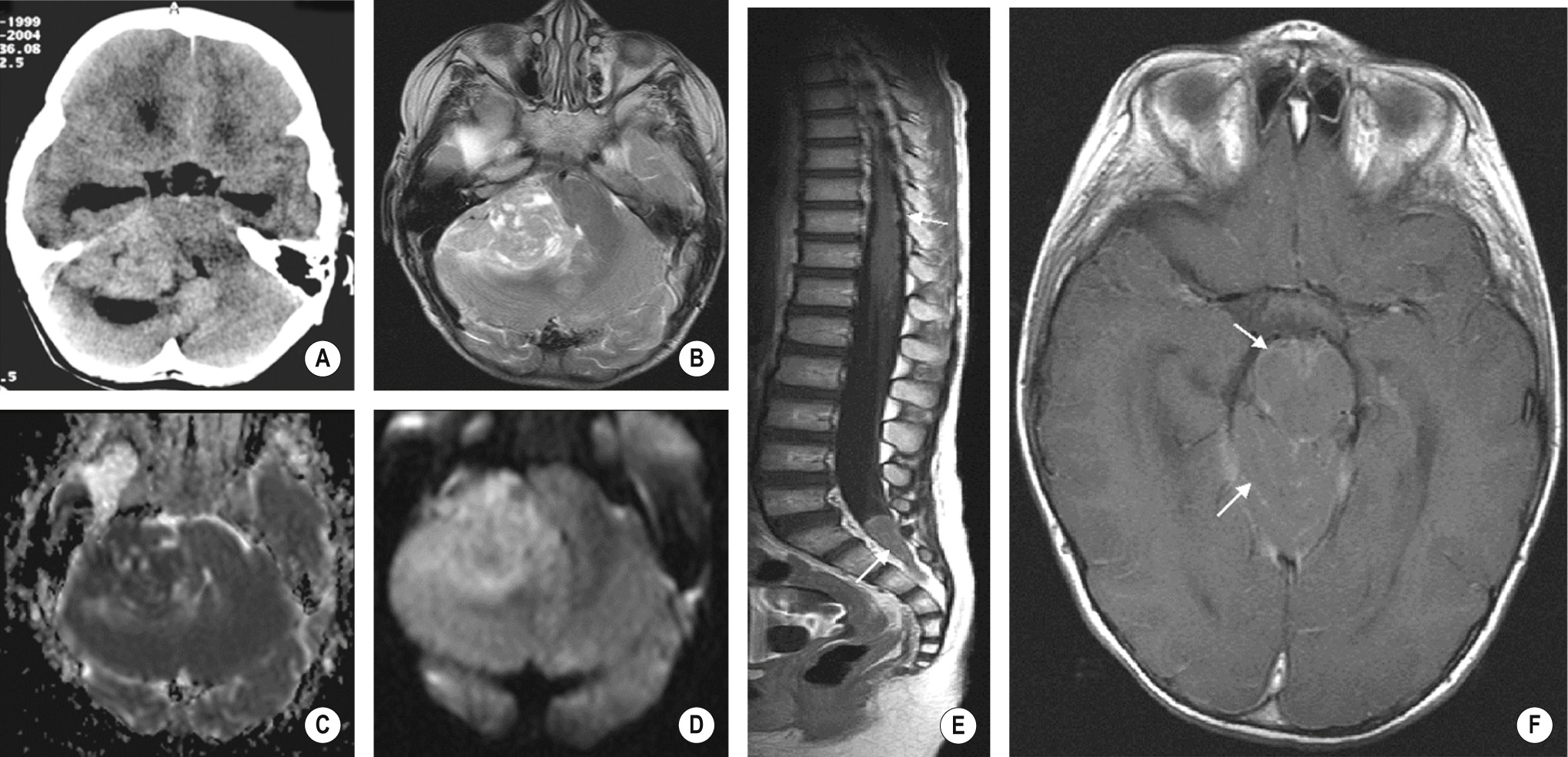 Medulloblastoma. (A) CT and (B–D) axial T2, ADC, and diffusion MRI show a mixed solid and cystic mass within the right cerebellopontine angle encroaching on the pons and fourth ventricle and causing hydrocephalus. The solid component is hyperdense on CT, hypointense on the T2WI and demonstrates restricted diffusion in keeping with a cellular tumour. It does demonstrate some less typical features, such as lateral site (more usually seen in older patients and associated with the desmoplastic variant) and cystic components. (E) There is nodular enhancement over the conus medullaris and a mass within the thecal sac. (F) In addition to pial enhancement over the midbrain and cerebellar folia (arrows), this is indicative of metastatic disease. *