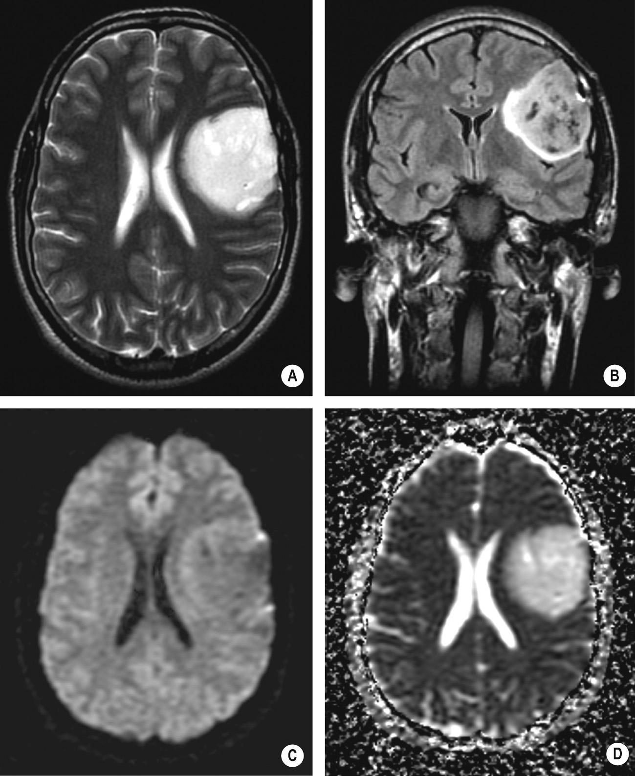 WHO grade II astrocytoma. Axial T2W (A), FLAIR (B) images showing a left frontal hyperintense mass lesion with well-defined borders and small cystic areas. On the trace-weighted DW image (C) the tumour is not very conspicuous as T2 effects and diffusion effects cancel each other out. On the ADC map (D) the glioma is easily identified as an area of increased diffusivity compared to normal brain parenchyma. *