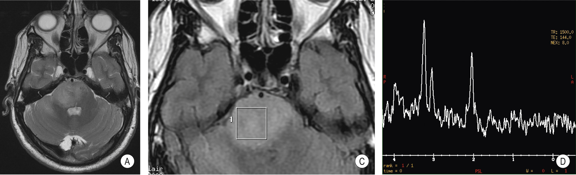 Proton magnetic resonance spectroscopy. (A) Single voxel magnetic resonance spectroscopy. Diffusely infiltrative brainstem glioma which is hyperintense on T2WI. A magnified FLAIR image (C) demonstrates placement of the spectroscopy voxel within the tumour. The spectrum (D) demonstrates that the choline peak (3.22 ppm) is elevated and much higher than the creatine peak (3.03 ppm) and the N -acetylaspartate peak (2.01 ppm). (CHO = choline, PCr/Cr = creatine, NAA = N -acetylaspartate). **