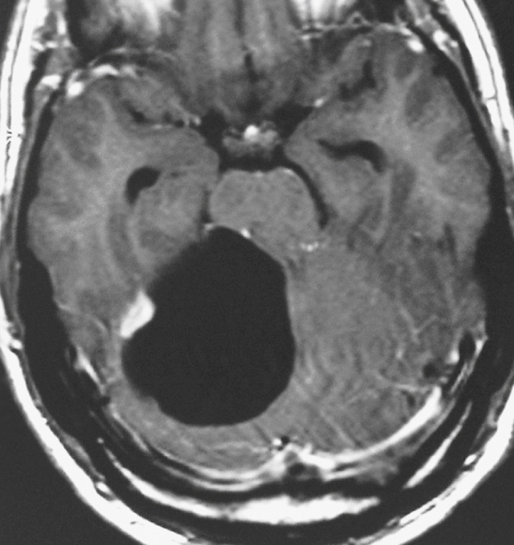 Cerebellar pilocytic astrocytoma. Axial T1W postgadolinium MRI. There is a cystic lesion in the cerebellum with a small, enhancing mural nodule but otherwise non-enhancing cyst wall. The fourth ventricle is compressed, causing hydrocephalus (note enlargement of the temporal horns). The differential diagnosis of this lesion is a cerebellar haemangioblastoma. **