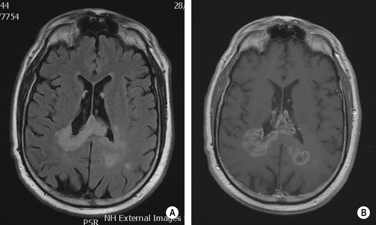 Glioblastoma. A 55-year-old patient with a ‘butterfly’ glioblastoma. The tumour appears hyperintense on FLAIR images (A) and infiltrates and thickens the splenium of the corpus callosum and surrounds the trigones of both lateral ventricles. On the post-contrast T1WI (B) the glioblastoma shows widespread inhomogeneous enhancement of the tumour. **