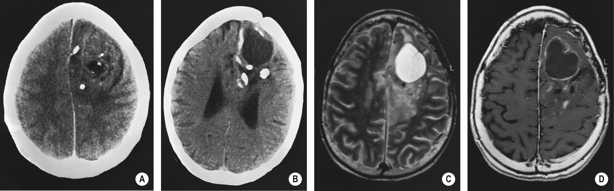 Oligodendroglioma. CECT (A) shows a large left frontal tumour that involves the cortex. It is predominantly solid with irregular enhancement, but there are also cysts and coarse calcification. Follow-up after 2 years with CT (B), T2WI (C) and T1WI + Gad (D) shows more extensive cyst formation and calcification (C). Note the left frontal craniotomy. *