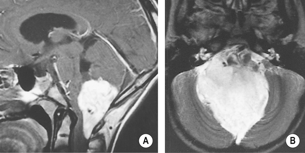 A large avidly enhancing ependymoma is shown on the sagittal T1WI + Gad (A) occupying the lower part of the 4 th ventricle, compressing the medulla and extending through the foramen of Magendie into the upper cervical canal. The axial T2WI (B) shows that the mass is high SI and also extends out through the lateral recesses into the cerebellopontine angles, particularly on the right. †