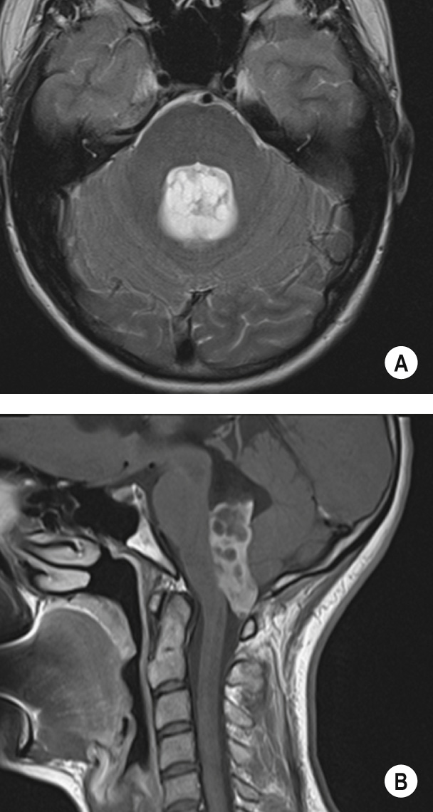 Ependymoma of the fourth ventricle. (A) The axial T2WI demonstrates a relatively well-circumscribed hyperintense partially solid and cystic mass expanding the fourth ventricle. (B) Sagittal post-contrast T1WI shows a heterogeneously enhancing mass expanding the inferior part of the fourth ventricle and extending through the foramen of Magendie. There is dilatation of the ventricular system in keeping with obstructive hydrocephalus. **