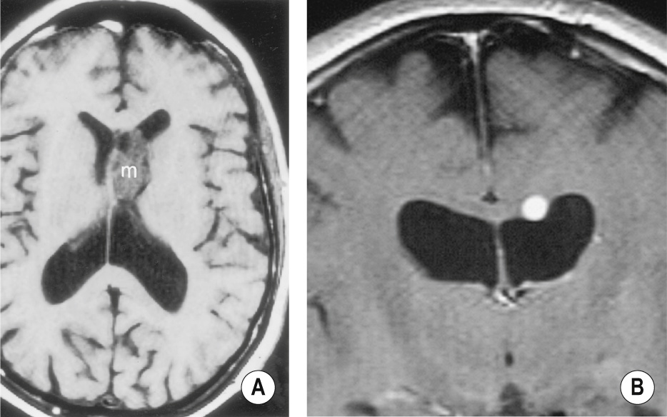 Supratentorial subependymoma. (A) A mass (m) is attached to the septum pellucidum and enlarges the left frontal horn. (B) A different enhancing lesion, on the outer surface of the ventricle. +