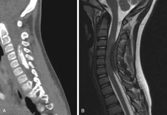 Figure 31.1, A 7-year-old boy with symptoms of myelopathy and left arm weakness. Cervical spine computed tomography (A) and magnetic resonance imaging (B) demonstrating an intradural calcified mass with canal compression suggestive of meningioma.