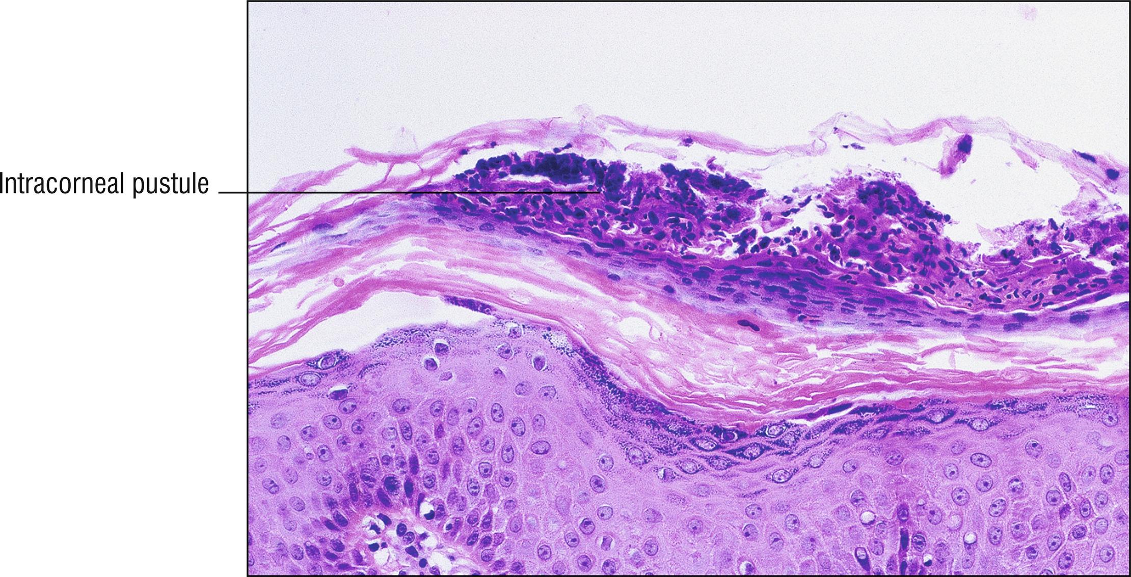 Fig. 5.1, Acropustulosis of infancy.