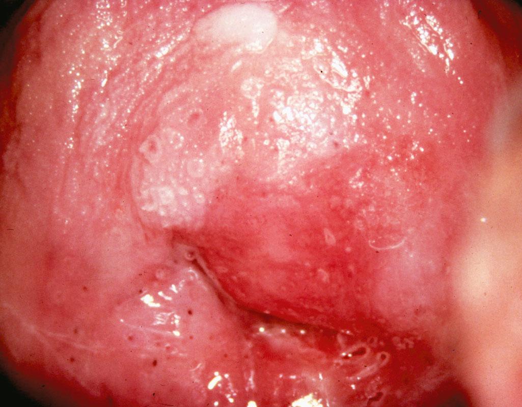 Fig. 29.1, Colpophotograph of a cervix with an active human papillomavirus infection. The patient had a cytologic sample reported as a low-grade squamous intraepithelial lesion. She was followed without treatment, and the lesions regressed over the next year.