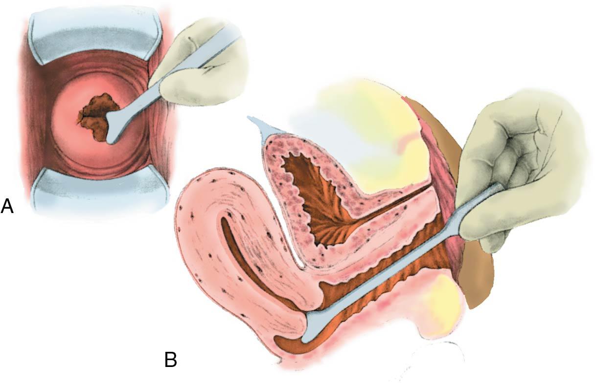 Fig. 29.2, Conventional Papanicolaou test. A spatula is often used to obtain a specimen from the exocervix. It must be used with an instrument that samples the endocervix. A, Cervix as seen through a speculum, with the spatula being used to obtain a cell sample. B, Longitudinal view at the same point in the procedure.