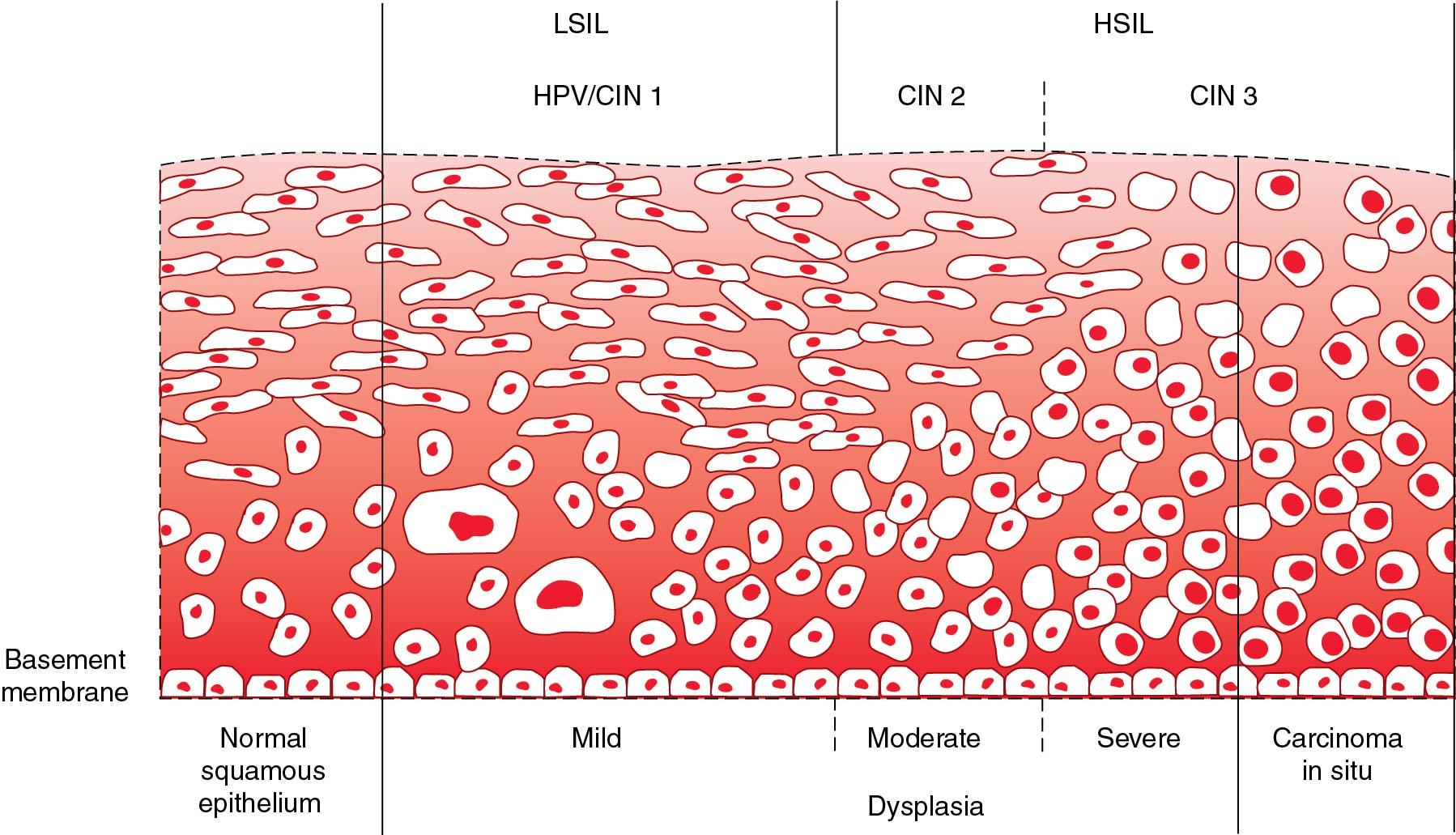 Fig. 29.4, Diagram of cervical epithelium showing various terminologies used to characterize progressive degrees of cervical neoplasia. CIN, Cervical intraepithelial neoplasia; HPV, human papillomavirus; HSIL, high-grade squamous intraepithelial lesion; LSIL, low-grade squamous intraepithelial lesion.