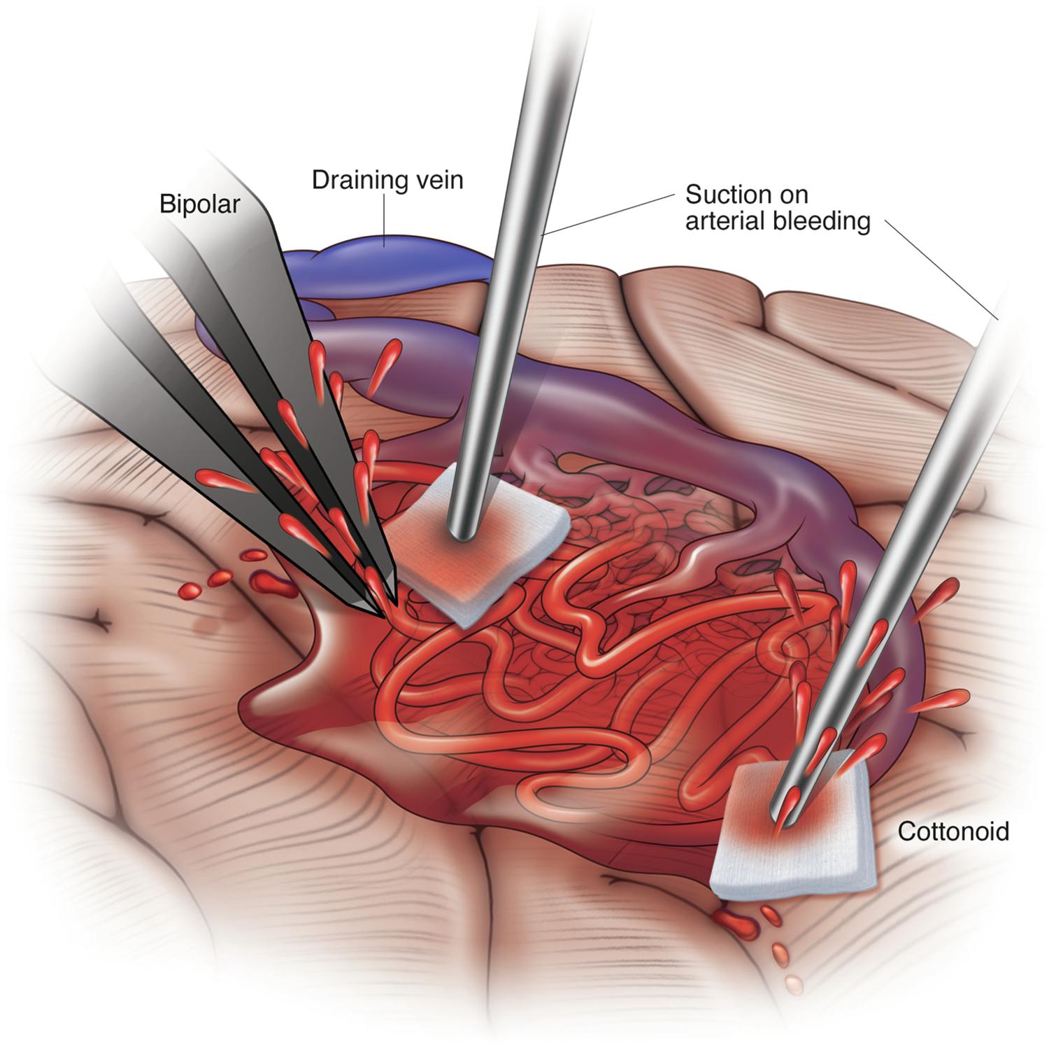 Fig. 37.1, Intraoperative bleeding. Robust arterial bleeding can quickly obscure the operative field during microsurgical resection of an AVM. It is imperative that the surgeon maintain a constant understanding of the location of the draining vein so as not to further amplify the bleeding. Cottonoids can be extremely beneficial in this situation.