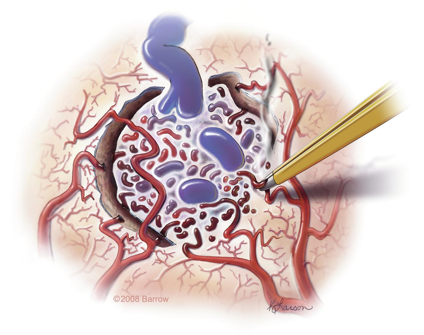 Fig. 37.2, Circumferential dissection, coagulation, and transection of small feeding arteries using the bloodless technique. Care is taken to preserve en passage vessels. This technique is sometimes facilitated by a gliotic plane created by the AVM. Other times, the parenchyma adheres to the AVM, and the surgeon must create a plane. In this scenario, the surgeon must balance getting too close to the nidus and inadvertently entering it with being too far into eloquent parenchymal tissue. When creating a plane, each small artery is coagulated before moving forward.