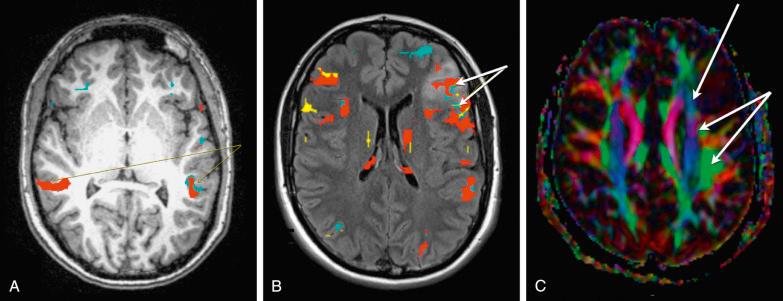 Figure 9.1, Preoperative imaging for a dominant-hemisphere lesion consistent with a low-grade glioma (WHO II). (A) Axial T1-weigthed MRI showing bilateral codominant activation of Wernicke's areas. (B) Axial T2-weighted FLAIR showing Broca's area with evident left dominance and involved within the lesion. (C) Axial DTI showing displacement of white matter tracts medially and the anatomic relation between the tumor (upper arrow) and the superior longitudinal fascicle (inferior arrow). If tumor excision/biopsy is recommended, this patient may require awake craniotomy with intraoperative mapping.