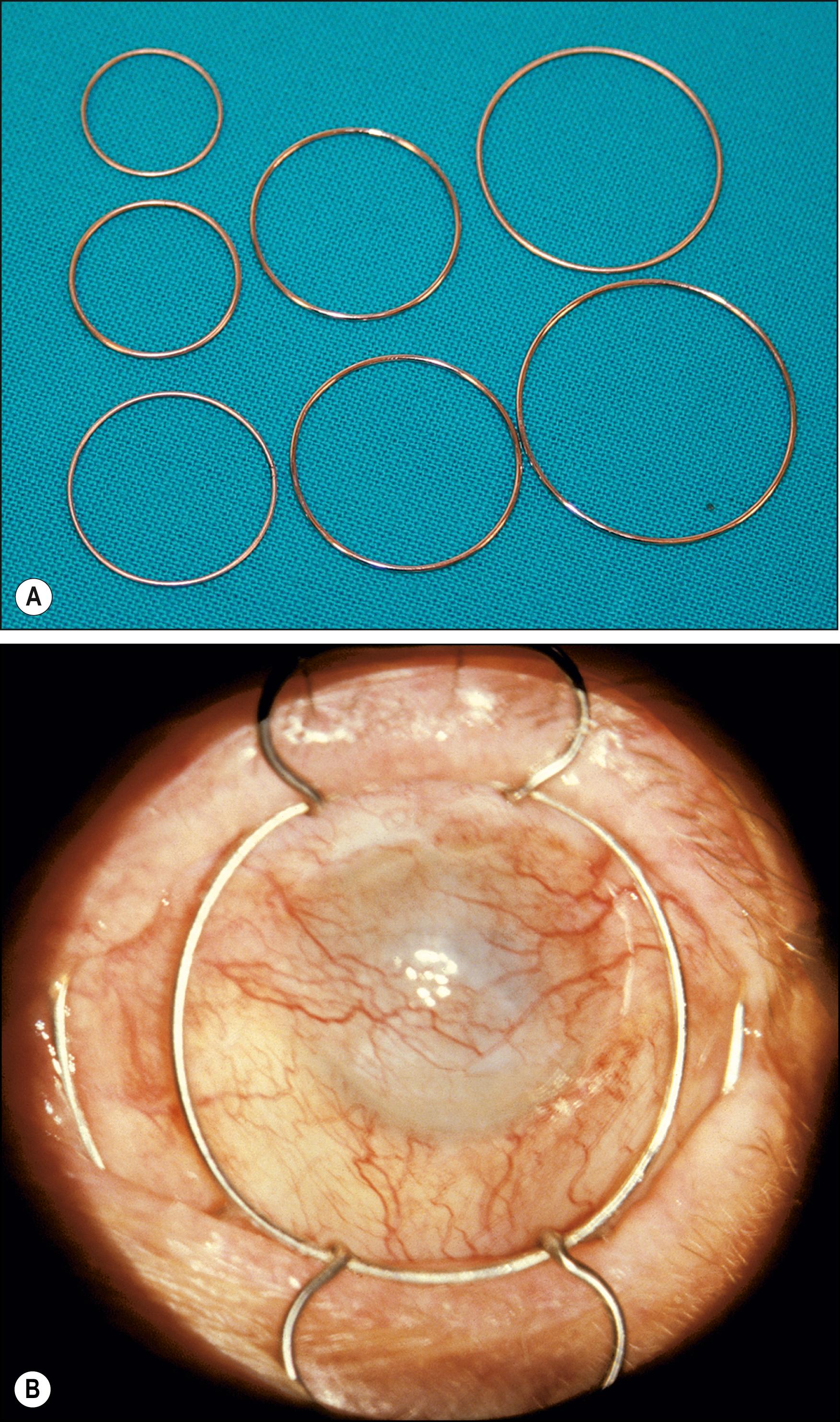 Fig. 112.1, ( A ) Flieringa rings of various sizes. ( B ) Globe fixation and lid retraction with a McNeill–Goldman blepharostat.