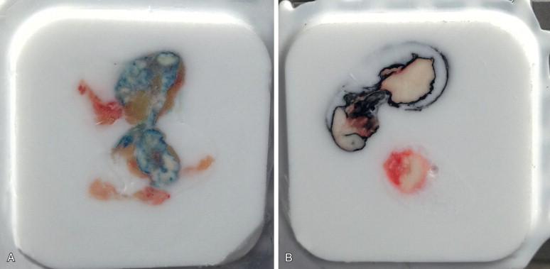 Figure 15-1, Handling of the sentinel lymph nodes. A, The sentinel lymph node with blue dye is bisected and entirely frozen. B, There are two lymph nodes for frozen section. The larger one is inked black and bisected. The specimen is entirely submitted. Multiple levels are cut, and a representative level is shown on the chuck in the cryostat.