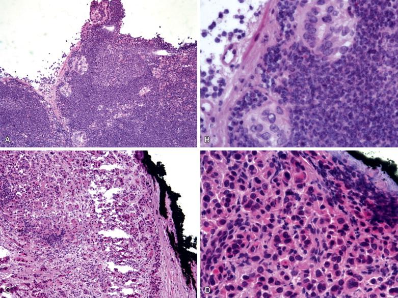 Figure 15-2, Ductal carcinoma of breast metastasis to axillary lymph nodes. A-B, A section from the specimen of Figure 15-1A shows atypical glands suggestive of tumor metastasis ( A, x100; B, x400); C-D, A section from the specimen of Figure 15-1B shows poorly differentiated ductal carcinoma of the breast ( C, x100; D, x400).