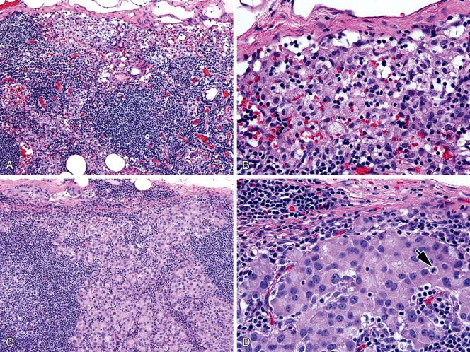 Figure 15-3, Histiocytosis versus metastatic carcinoma in sentinel lymph nodes. A-B, Subcapsular histiocytosis showing histiocytes with a low N:C ratio and inconspicuous nucleoli. Some cells have a foamy cytoplasm ( A, x100; B, x400). C-D, Subcapsular metastasis of ductal carcinoma of the breast showing a high N:C ratio, mitotic figure (arrow), and prominent nucleoli of most of the tumor cells ( C, x100; D, x400).