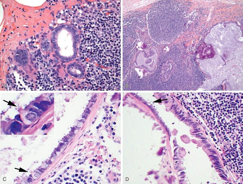 Figure 15-5, Endosalpingiosis identified in an axillary sentinel lymph node. A-B, Histologically normal glands with cystic changes ( A, x400; B, x40). C-D, Cilia (arrows) identified in the lining cells of the cyst ( C, x600; D, x400).