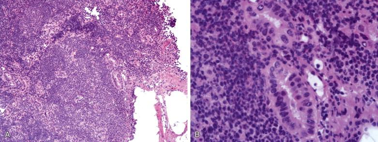 Figure 15-6, Metastatic ductal carcinoma of the breast ( A, x100; B, x400) mimics benign glands in an axillary lymph node.