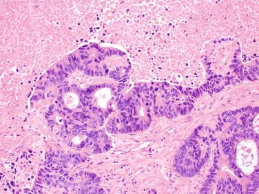 Figure 11-1, A classic example of colorectal adenocarcinoma showing glandular structures with a cribriform pattern. Necrotic debris (“dirty necrosis”) is evident.