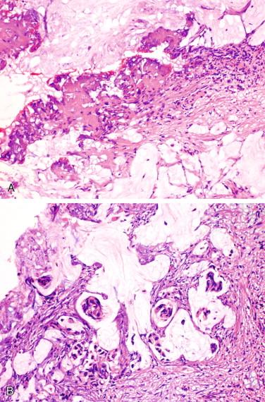 Figure 11-2, Frozen section of a peritoneal nodule from a patient with colonic adenocarcinoma, which showed acellular mucin only on initial sections (A) but metastatic adenocarcinoma on deeper sections (B). Note the presence of marked cautery effects, which may make histologic assessment difficult.