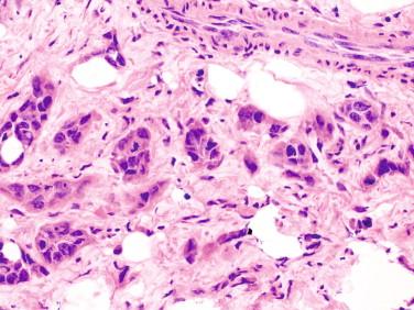 Figure 11-3, Frozen section of a peritoneal nodule from a patient with colonic adenocarcinoma, which showed metastatic poorly differentiated adenocarcinoma.