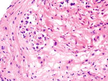 Figure 11-4, Mesothelial hyperplasia showing a cluster of mesothelial cells in a fibrotic stroma. These cells contain abundant eosinophilic cytoplasm and lack significant nuclear atypia. Single individual cells are also present.