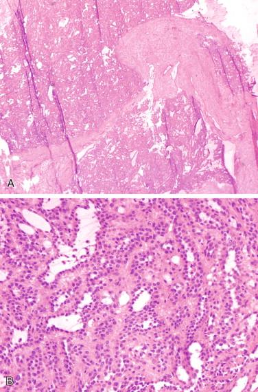 Figure 11-5, Frozen section of an adenomatoid tumor showing complex tubular structures on low-power view (A). Higher-power view shows small spaces lined by uniform cuboidal cells (B) .