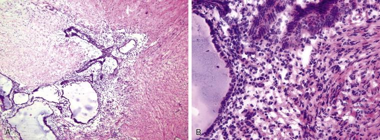 Figure 11-6, Endometriosis involving the serosa of the bowel. Glandular structures surrounded by endometrial-type stroma are recognizable on low-power view (A) . Higher-power view shows proliferative/inactive-type endometrium with characteristic stroma (B) .