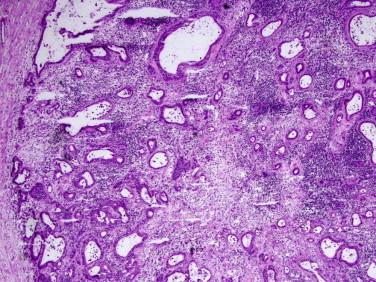 Figure 10-1, Metastatic adenocarcinoma (irregular and infiltrating malignant glands) in lymph node (H&E stain, x40).