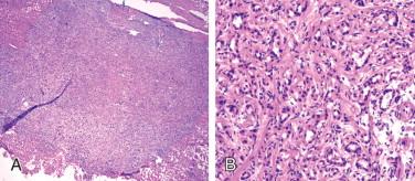Figure 10-2, Incidental bile duct adenoma as a subcapsular liver lesion characterized by nodular proliferation of ductular structures ( A, H&E stain, x20; B, H&E stain, x200).