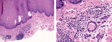 Figure 10-3, A, Positive proximal margin in an esophagectomy performed for BE-associated adenocarcinoma (H&E stain, x100). B, Subepithelial extension of the adenocarcinoma (H&E stain, x400).