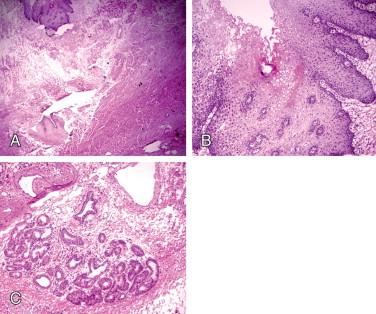 Figure 10-5, A, Negative proximal margin. A, Full thickness section (H&E, x20). B, Benign squamous epithelium (H&E stain, x100). C, Lobular arrangement of submucosal mucous glands (H&E stain, x100).