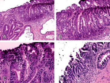 Figure 10-6, BE-associated high-grade dysplasia at the proximal margin. Crowding and slightly irregular glands are in the lamina propria ( A, H&E, x100; B, H&E stain, x200). C, These glands are lined by epithelial cells with hyperchromatic and enlarged nucleus (H&E stain, x400). D, Permanent section (H&E stain, x200).